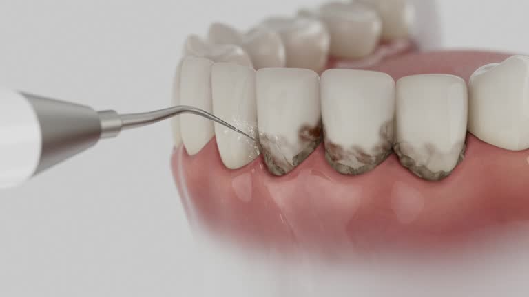 Reliable Dental Implants contractor in Woods Cross, UT by Smile Center Dentistry
